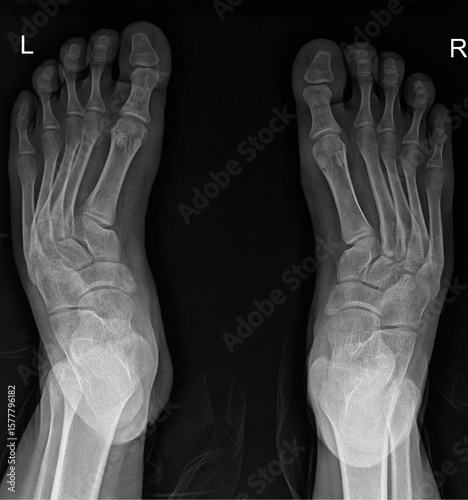X-ray both feet with a clear view of the phalanges, metatarsals, and tarsal bones.