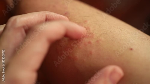 Scratching a rash on leg skin