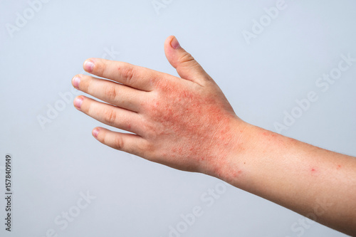 Canvastavla Red rashes from the Coxsackie virus on child hand on white background
