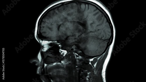 A detailed MRI scan of a human brain from a side view. The scan reveals the intricate structures of the brain, including the cerebral cortex, ventricles, and brainstem