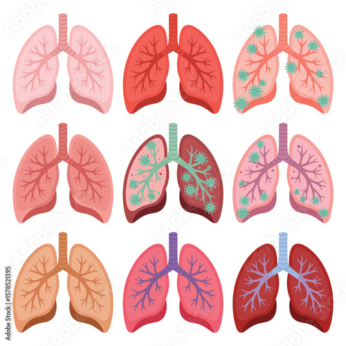Human Lungs Illustration Showing Stages of Infection