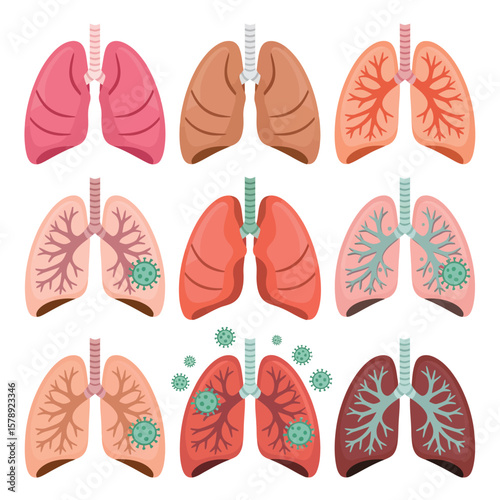 Lungs with Viral Infection Stages