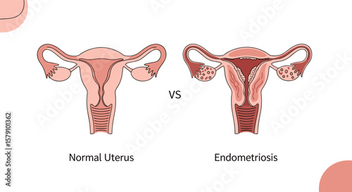 Understanding endometriosis versus a normal uterus for women's health