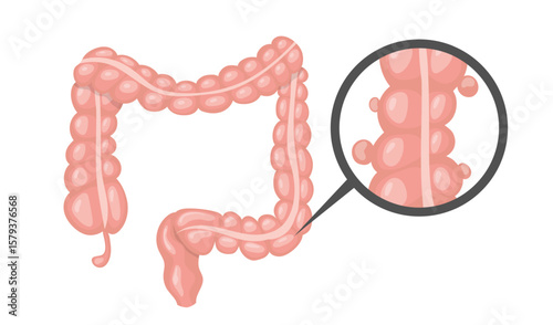Diverticulosis affecting large intestine highlighted by magnifying glass