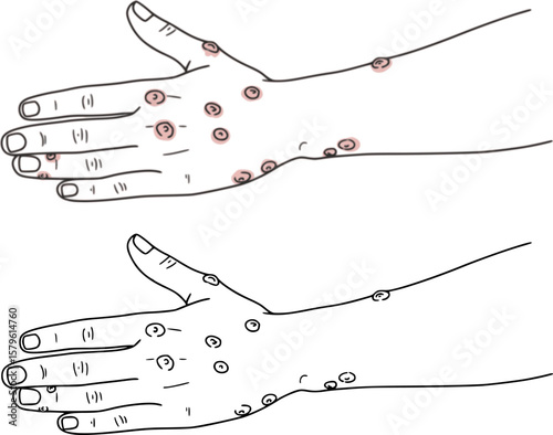 chicken pox on the hands outline
