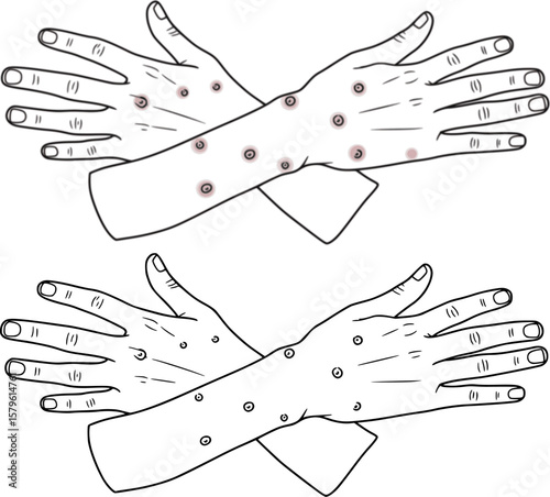 chicken pox on the hands outline
