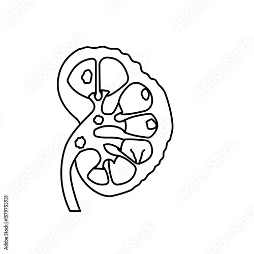 chronic kidney disease