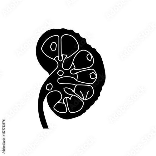 chronic kidney disease