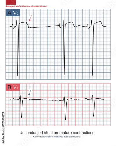 Obraz na plátně When premature atrial contractions occur too early, conduction disruption occurs due to the refractory period of the downstream conduction system, which is called unconductive PACs