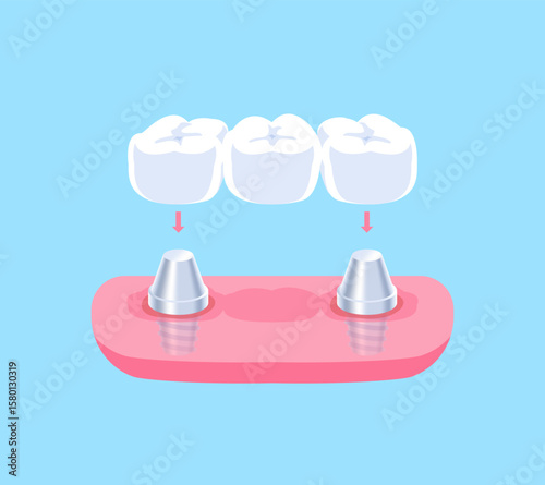 Implant supported bridges teeth illustration vector design. Dental care concept.