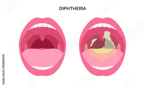 Diphtheria oral disease