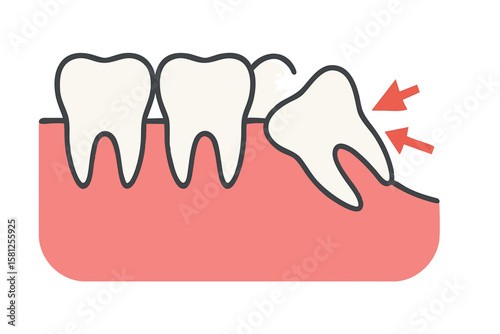 Flat vector wisdom tooth growing sideways in jaw with pressure arrows, dental surgery case, isolated on white