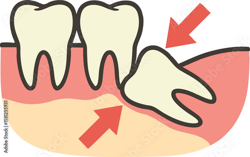 Flat vector wisdom tooth growing sideways in jaw with pressure arrows, dental surgery case, isolated on white
