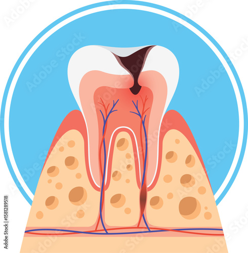 Dental cavity third progress stage