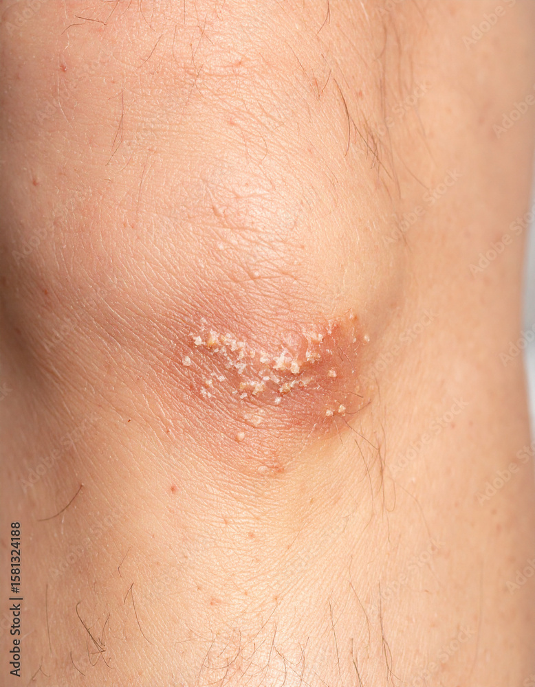Fototapeta premium A close-up of granulated skin forming unevenly around an infected wound on a man�s leg with discoloration.