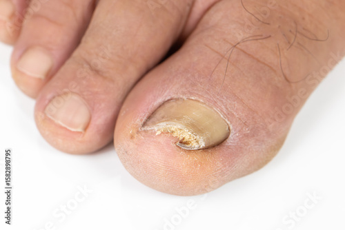 Φωτογραφία Ingrown toenail on a senior feet with white background
Close-up ingrown toenail on senior feet with white background
