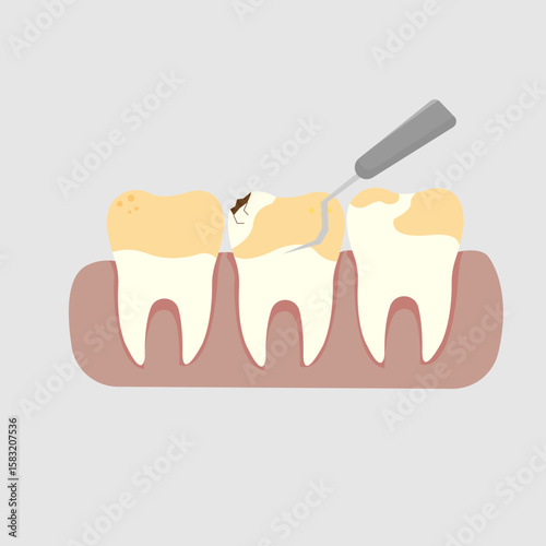vector illustration of cleaning tartar on teeth with a special tool