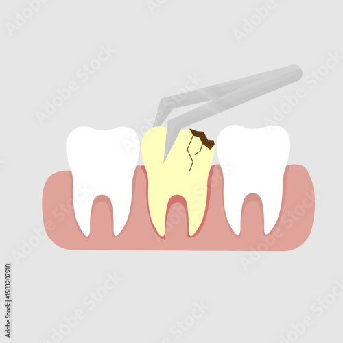 vector illustration of a cavity being cleaned