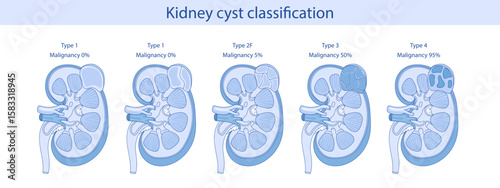 Anatomy of a human kidney cyst. Vector anatomical illustration