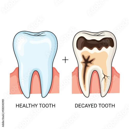 Illustration comparing a healthy tooth with a decayed tooth, showing dental health.