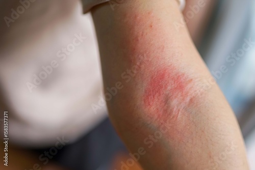 Asian woman has red rash on her right arm 
