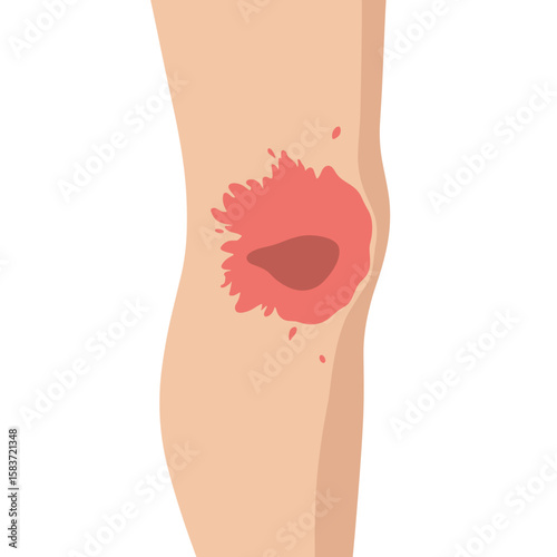 Illustration of a knee with a wound and red inflamed area  