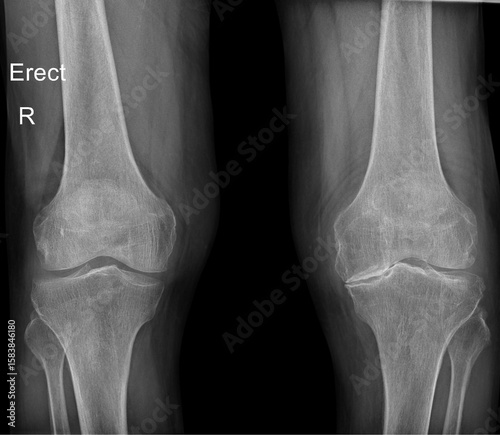 Standing Anteroposterior Knee X-ray: Load-bearing Assessment