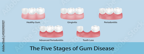 White teeth,gum.Five Stages of Gum Disease Diagram,Medical Infographic of Healthy Gum,Gingivitis,Periodontitis,Advanced Periodontitis,Tooth Loss.Concept for Educational Medical Oral Health,Dental Care