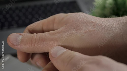 Papillomas on hands may not pose serious health risk, but they can be unsightly and cause self-consciousness. Seeking medical advice can provide relief and peace of mind regarding their management