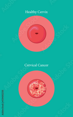 Cervical cancer versus healthy cervix, detailed medical comparison illustration. eps 10