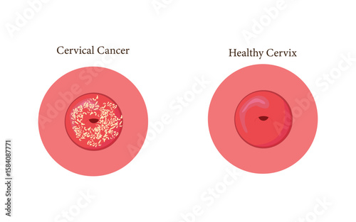 Anatomical diagram showing cervical cancer next to normal cervix structure. eps 10