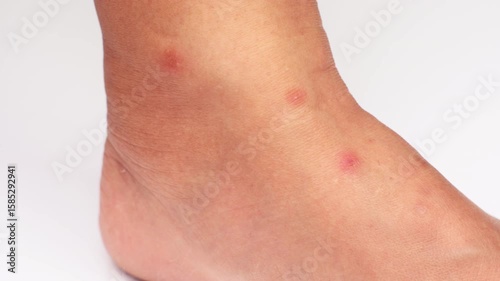 Close up view of flea bites on lower legs and feet skin.