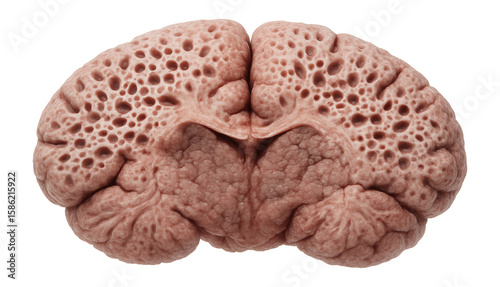Prion-induced vacuolated brain tissue with spongiform appearance