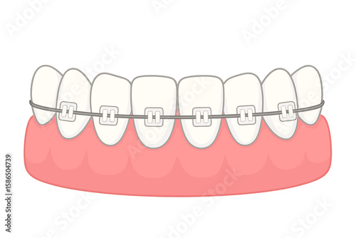 Orthodontic braces on teeth vector illustration. Dental care concept for smile alignment and bite correction. Metal bracket system for oral hygiene and healthcare treatment.