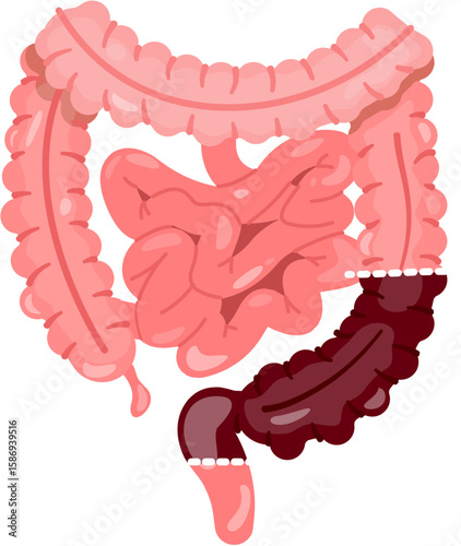 Tableau sur toile High Anterior Resection