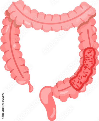 Ulcerative colitis 