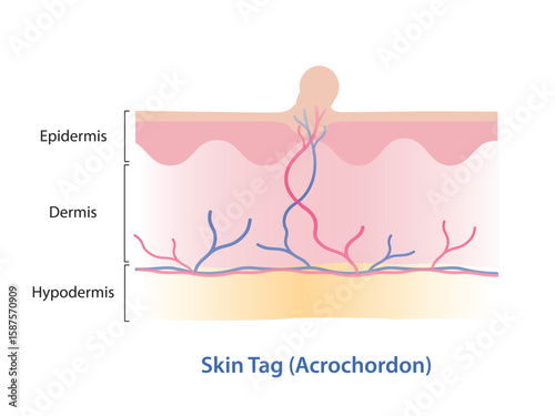 Infographic of skin tag vector illustration. Skin tag is small excess piece of skin that protrude from surface skin, often grow on neck, armpits, eyelid, under breast, groin, thigh and genital.