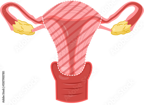Total Hysterectomy 