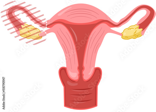 Salpingo Oophorectomy 