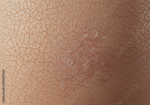 Dry cracked skin closeup