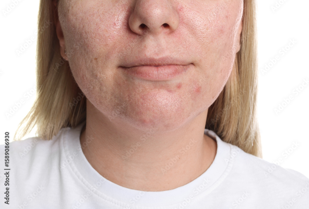 Obraz premium Woman with acne problem on white background, closeup