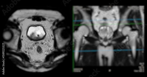MRI scan reveals an enlarged prostate gland, a possible indicator of prostate cancer. Explore the critical signs and how MRI can assist in early detection.