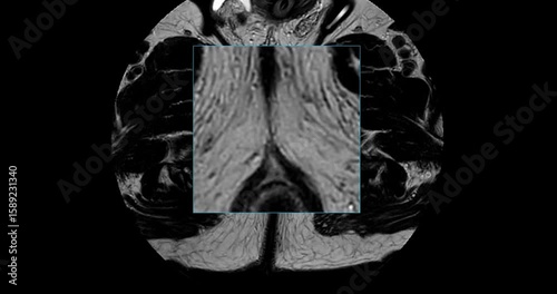 MRI scan reveals an enlarged prostate gland, a possible indicator of prostate cancer. Explore the critical signs and how MRI can assist in early detection.