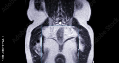 MRI scan reveals an enlarged prostate gland, a possible indicator of prostate cancer. Explore the critical signs and how MRI can assist in early detection.