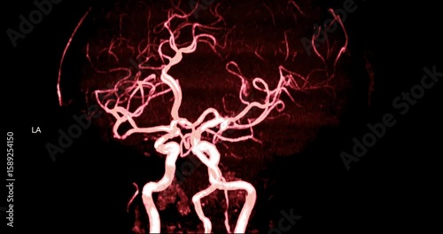 MRA Brain or Magnetic resonance angiography of Cerebral artery turn around on the screen. MRA Brain MIP view for evaluate cerebral artery.