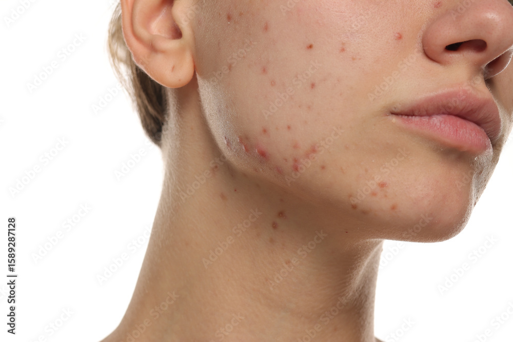Obraz premium Close-up of young woman's jawline with visible acne, studio shot on white background.