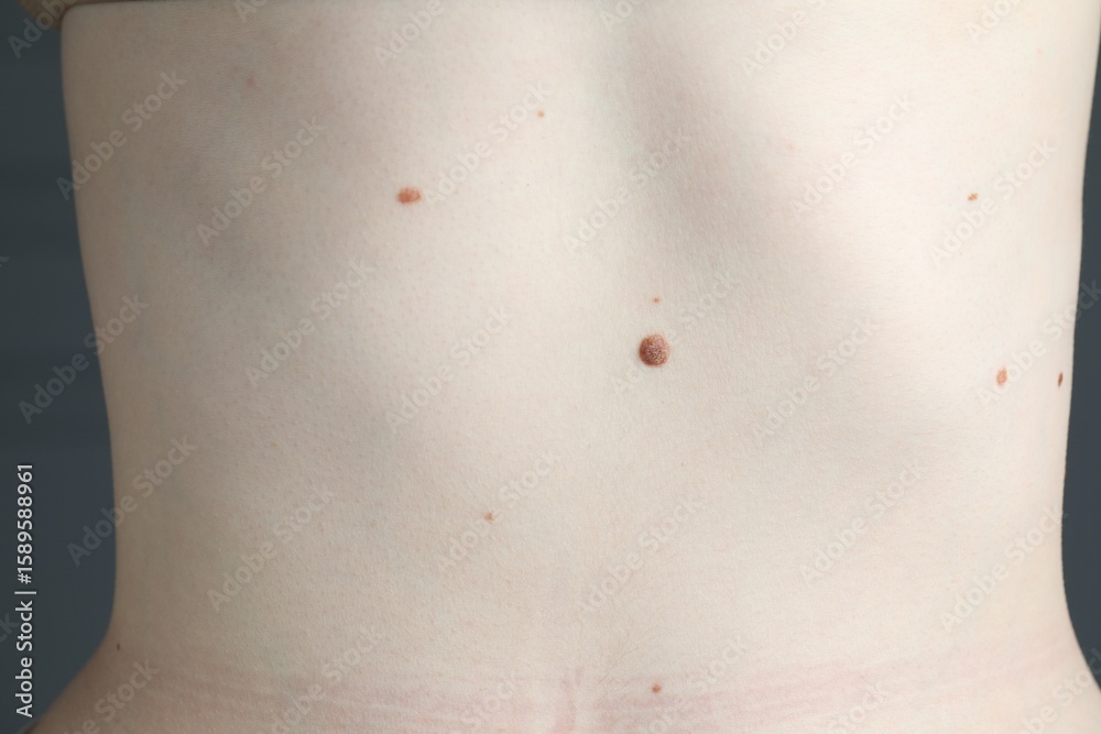 Fototapeta premium Woman with moles on her skin, macro view