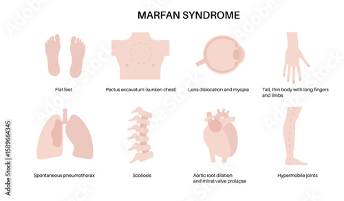 Marfan syndrome poster
