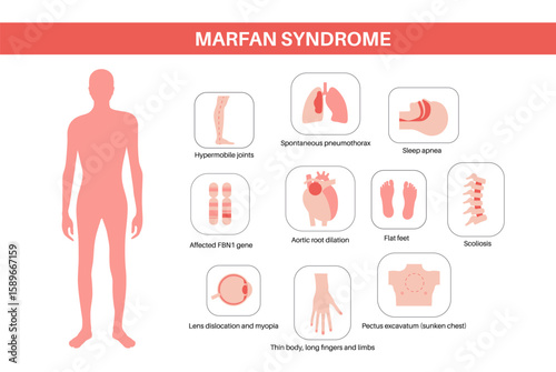Marfan syndrome poster