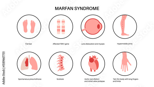 Marfan syndrome poster